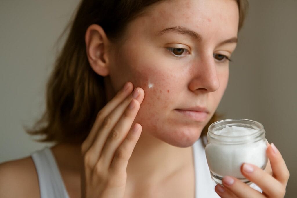 Czy można stosować olej kokosowy na skórę trądzikową? Pytamy dermatologów